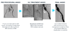 A panel angiographic sequence illustrating a vascular intervention including pre-procedural angiogram, IVL treatment, and final angiogram