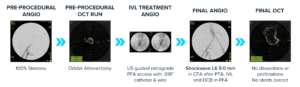 A panel angiographic and OCT sequence illustrating a vascular intervention including pre-procedural angiogram, pre-procedural OCT run, IVL treatment angiogram, final angiogram, and final OCT