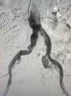 shockwave l6 pre-procedural angio scan