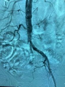 shockwave l6 pre-procedural angio scan