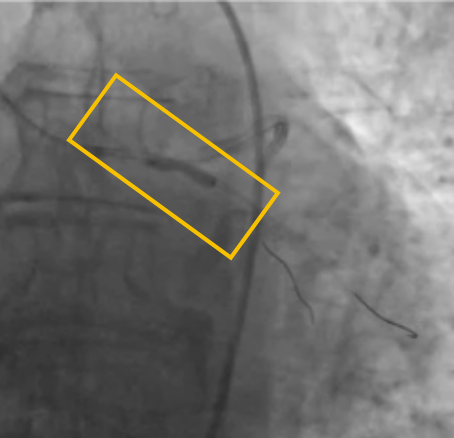 vessel prep w coronary ivl scan