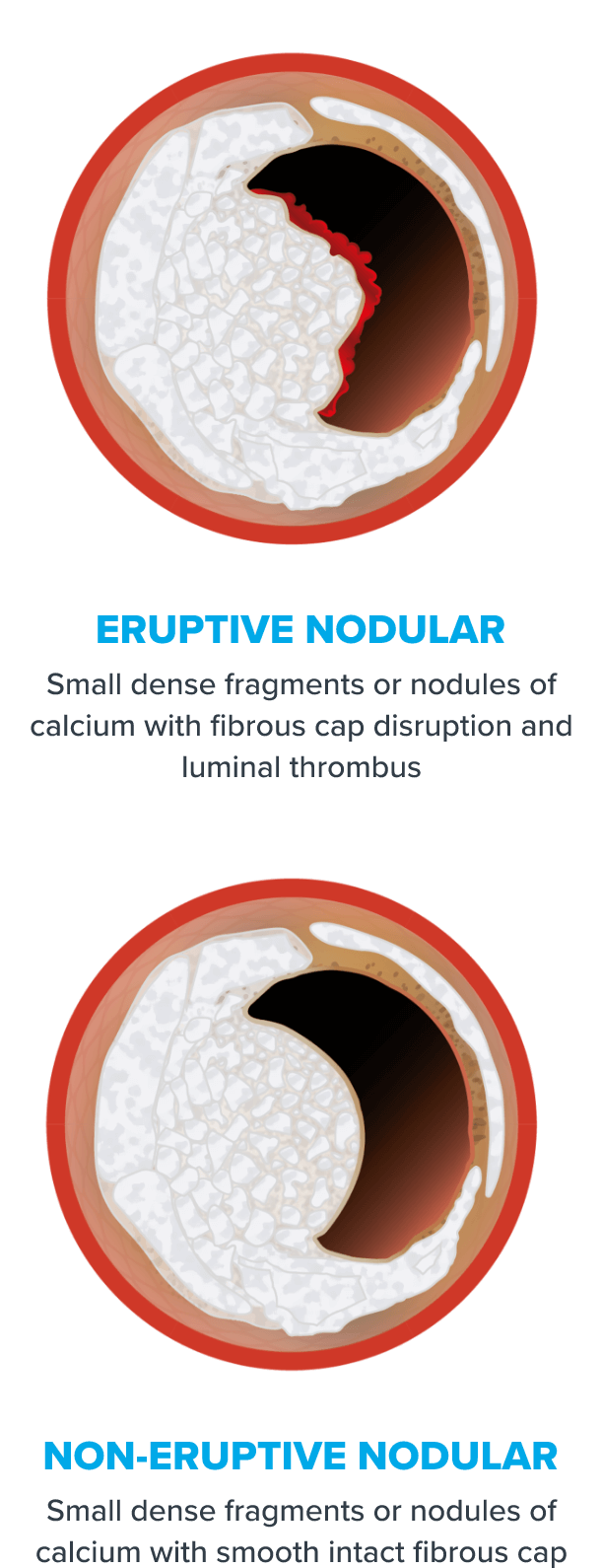 eruptive and non-eruptive calcified nodules