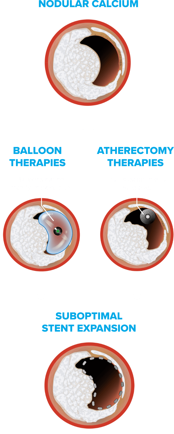 balloon therapies