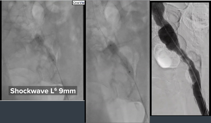 shockwave l6 ivl treatment angio scan