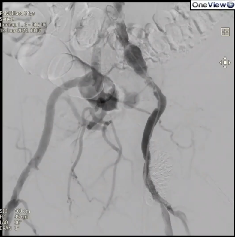 shockwave l6 pre-procedural angio scan