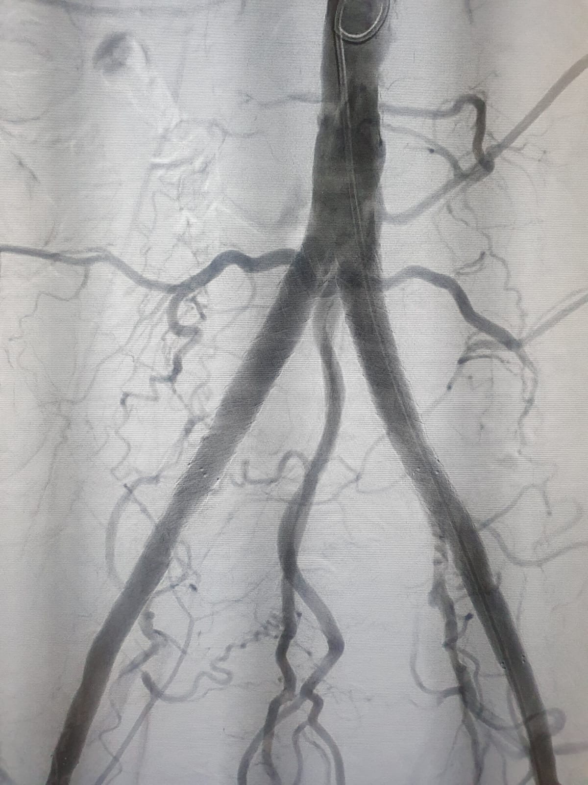 shockwave l6 final angio scan