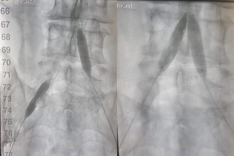 shockwave l6 ivl treatment angio scan