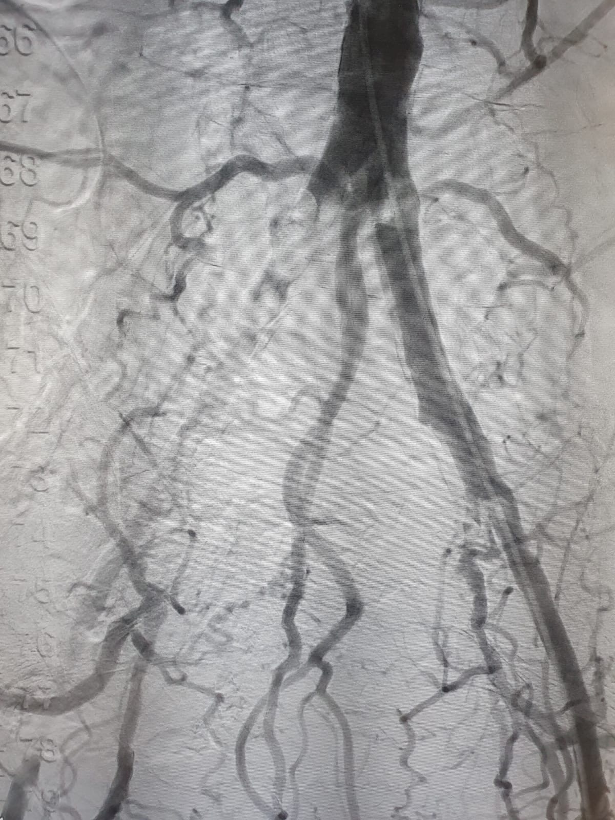 shockwave l6 pre-procedural angio scan