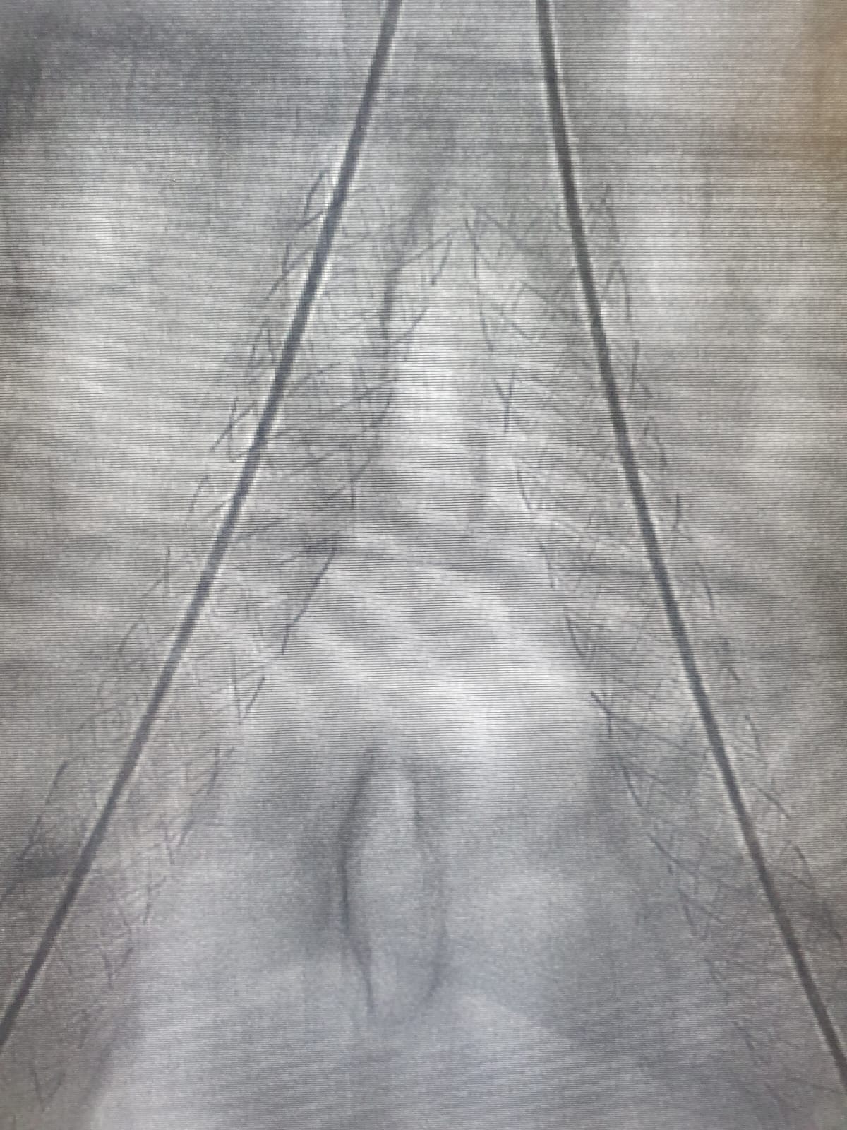 stent deployment