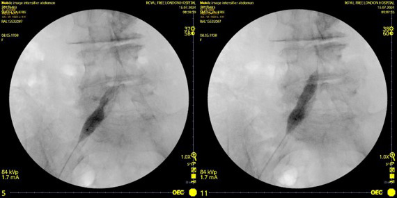 shockwave l6 ivl treatment scan