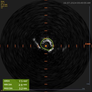 shockwave l6 pre-procedural oct run