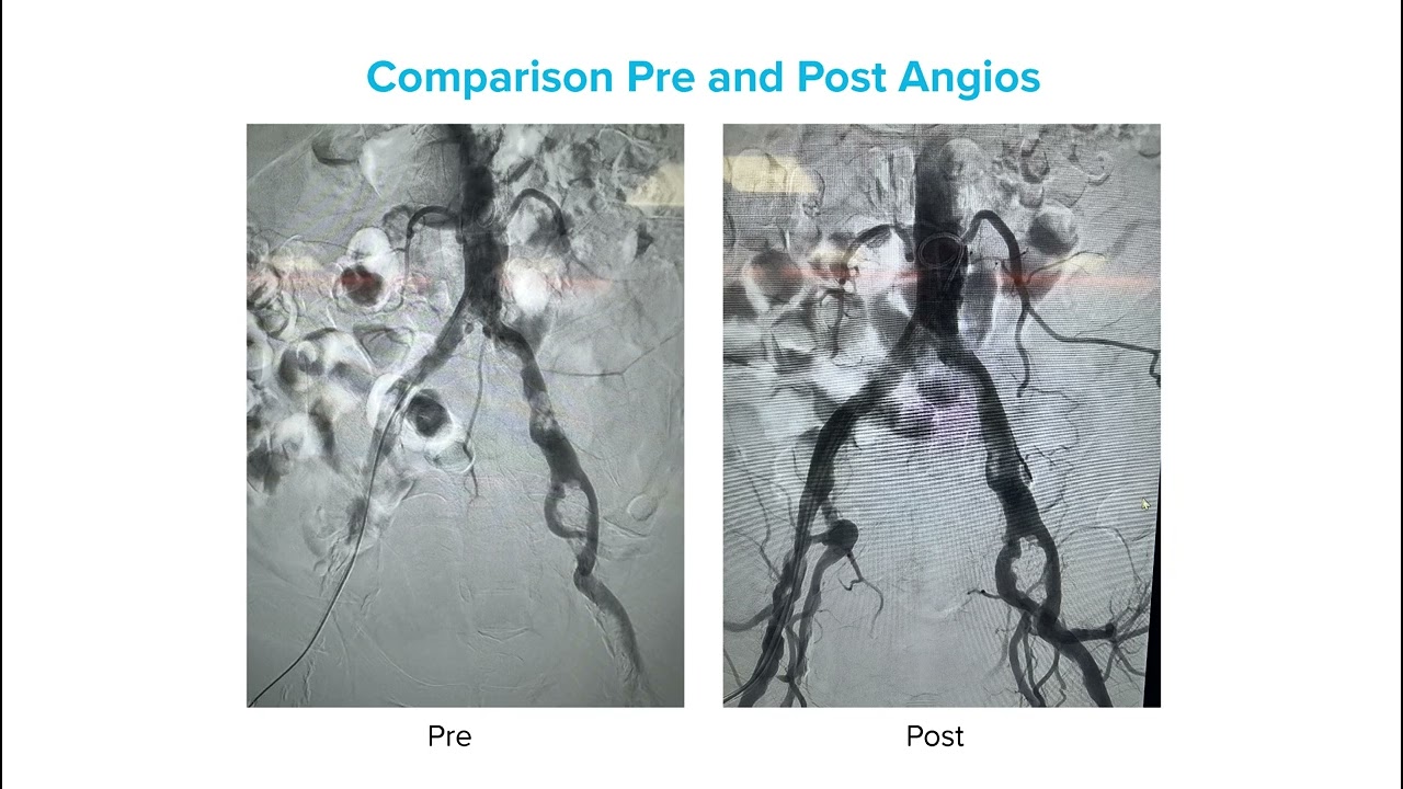 Shockwave L6 Case Review with Professor Fazzini