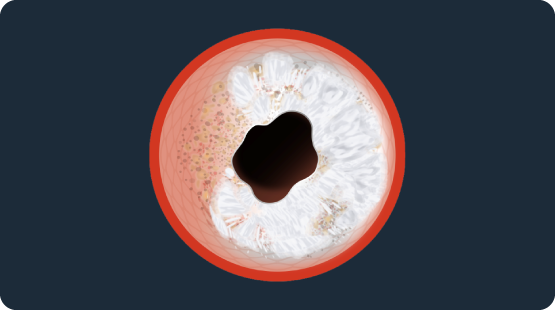 Cross-sectional illustration of an artery with concentric calcified plaque buildup