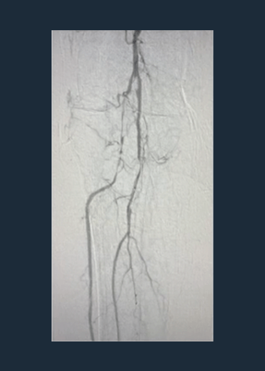 Dr. JD Corl Case Review: Below-the-Knee Disease in Patient with CLTI 