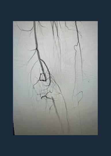 Dr. Nicolas Mouawad Case Review: Distal SFA CTO