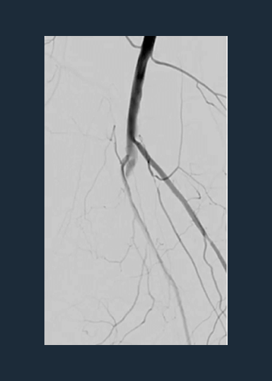 Dr. Raj Pyne Case Review: Popliteal CTO in Patient with CLTI