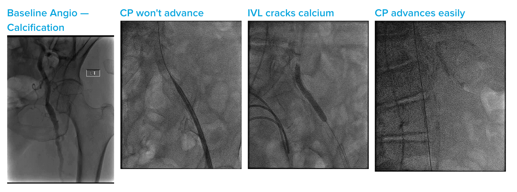 Transfemoral Impella In Calcified Iliacs - Shockwave Medical