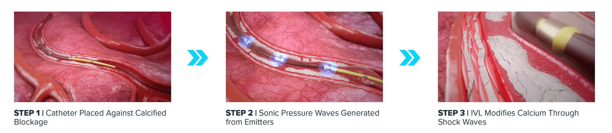 How Shockwave IVL works: Step one, catheter is placed against calcified blockage; Step two, sonic pressure waves are generated from emitters; Step three, IVL modified calcium through shock waves