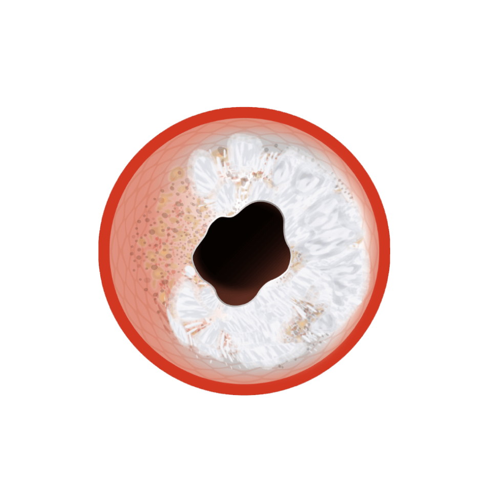 Digital rendering of cross-sectional view of blood vessel showing concentric calcification