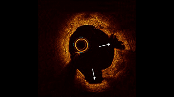 Intravascular imaging cross-section within a calcified artery post-ivl