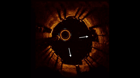 Intravascular imaging cross-section showing stent deployment within an artery.
