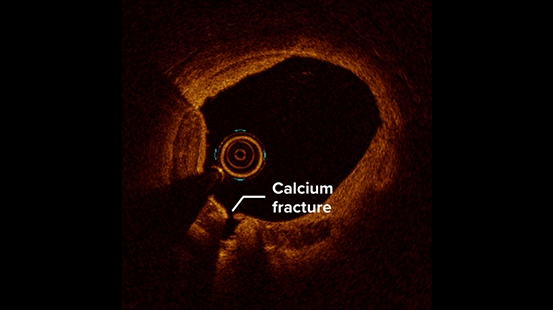 Intravascular imaging showing a cross-section of an artery with a visible calcium fracture, highlighted and labeled on the arterial wall.