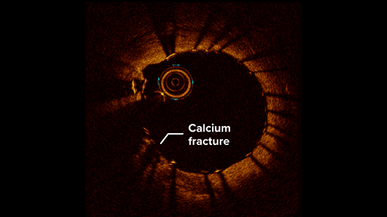 Intravascular imaging showing a cross-section of an artery with a visible calcium fracture, highlighted and labeled on the arterial wall.