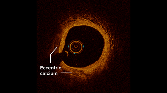 Intravascular imaging showing a cross-section of an artery with eccentric calcified plaque, indicated by a labeled region on one side of the arterial wall.