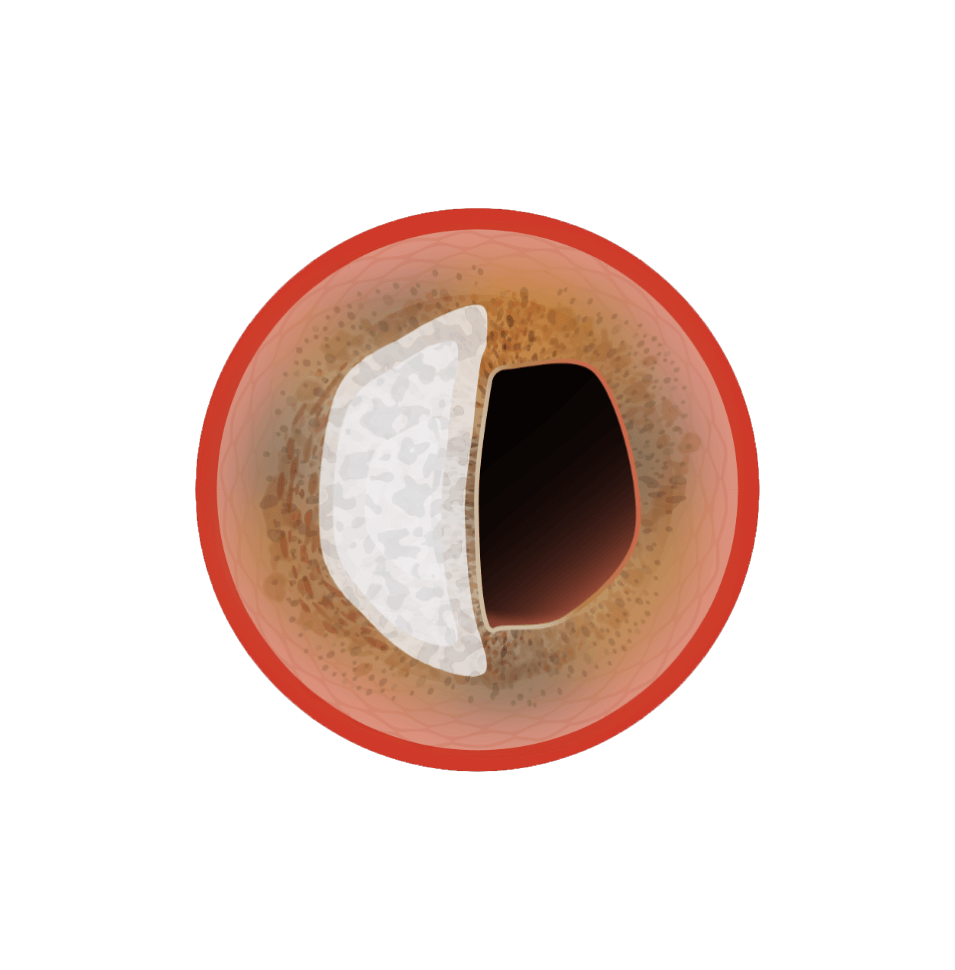 Digital rendering of cross-sectional view of blood vessel showing eccentric calcification