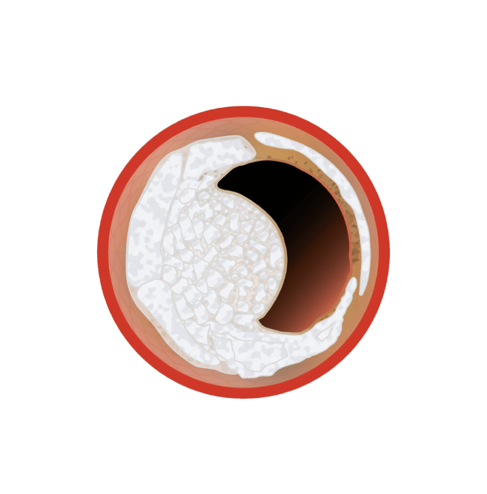 Digital rendering of cross-sectional view of blood vessel showing nodular calcification
