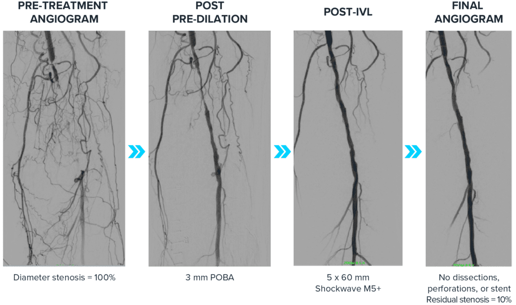Series of four angiogram images showing the progression of a peripheral artery treatment with intravascular lithotripsy (IVL) above the knee