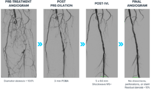 Series of four angiogram images showing the progression of a peripheral artery treatment with intravascular lithotripsy (IVL) above the knee