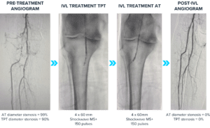 健康・医学 Occlusion Frontiers | Head-to-head comparison of commercial artificial