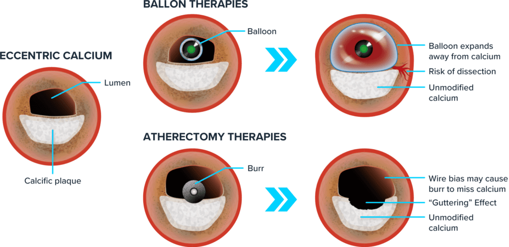 Illustration comparing balloon and atherectomy therapies in treating eccentric calcium in arteries.