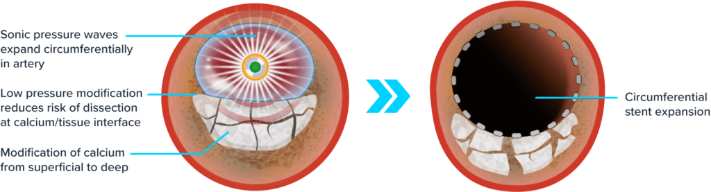 Illustration of intravascular lithotripsy (IVL) therapy in treating calcified arteries, showing both initial and post-treatment stages.