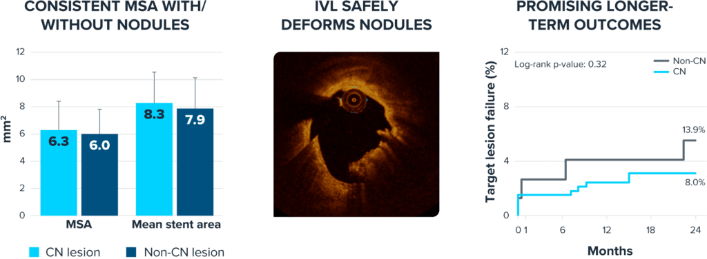 Composite image showing three key findings related to intravascular lithotripsy (IVL) with calcified nodules.
