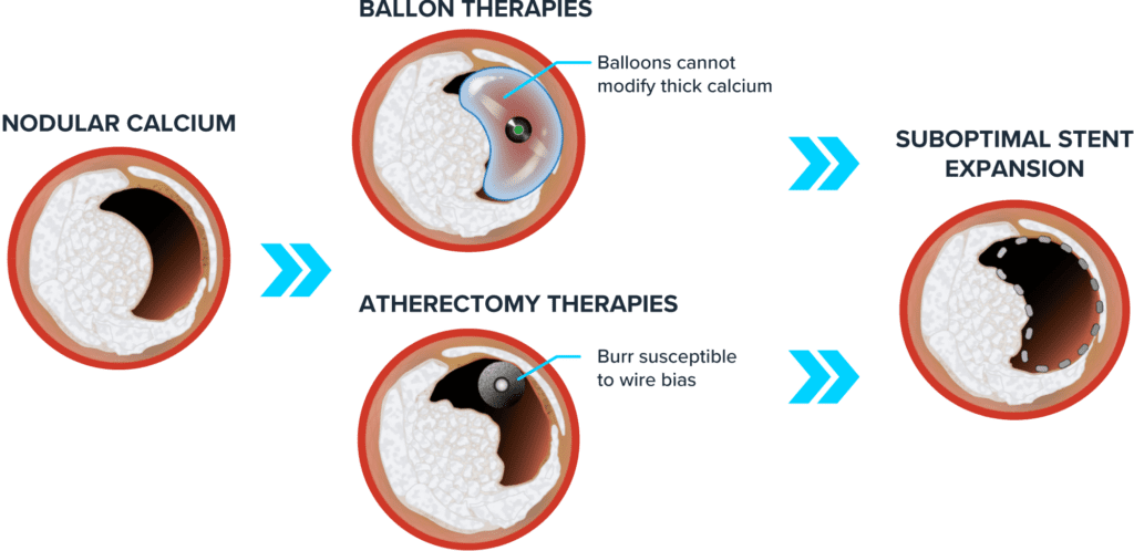 Illustration showing the challenges of treating nodular calcium in arteries with balloon and atherectomy therapies, leading to suboptimal stent expansion.