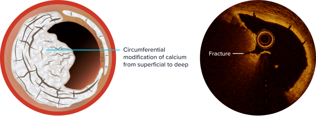 Illustration comparing a cross-sectional view of calcium modification with intravascular lithotripsy (IVL) and an optical coherence tomography (OCT) image showing a fracture in calcified tissue.