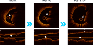 Three sequential cross-sectional OCT images and corresponding longitudinal views illustrating stages of intravascular lithotripsy (IVL) treatment on a calcified artery with a nodular calcified lesion
