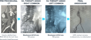 Series of four images showing the treatment of heavily calcified iliac arteries with intravascular lithotripsy (IVL) prior to EVAR (endovascular aneurysm repair)