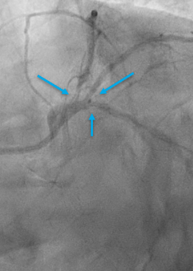 Heavily Calcified LM Trifurcation With Hemodynamic Support - Shockwave ...