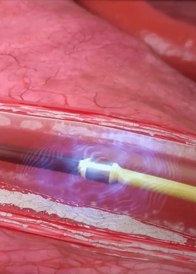 shockwave-ivl-mechanism-of-action-shockwave-medical