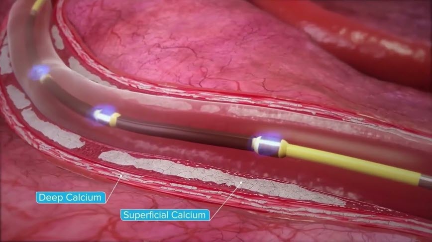 Thumbnail animated image of Shockwave IVL catheter inside the vasculature modifying deep and superficial calcium