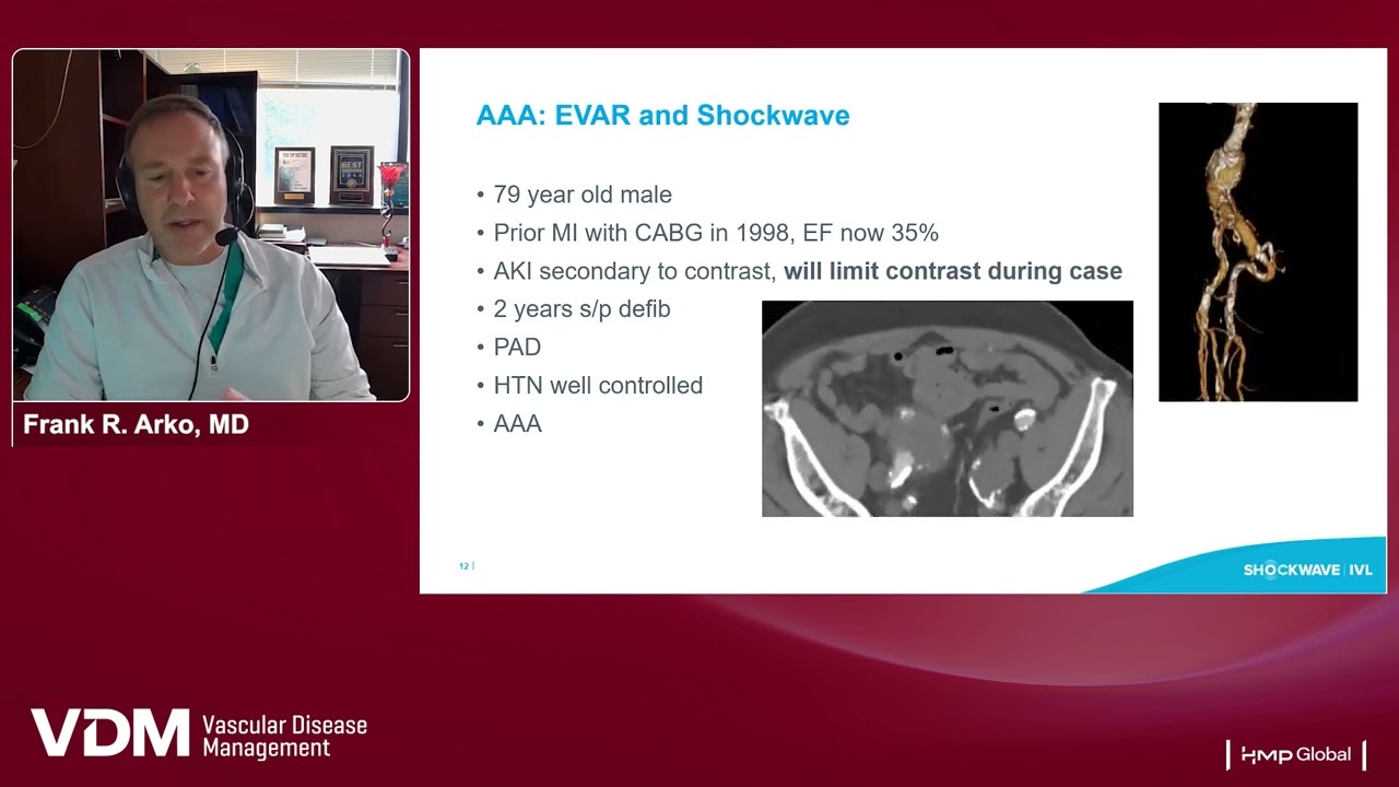 Youtube Thumbnail of medical professional talking about EVAR and shockwave