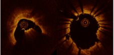 Two cross-sectional intravascular images showing the effects of IVL (Intravascular Lithotripsy) on calcified vessels.