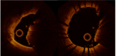 Two cross-sectional intravascular images showing the effects of IVL (Intravascular Lithotripsy) on calcified vessels.