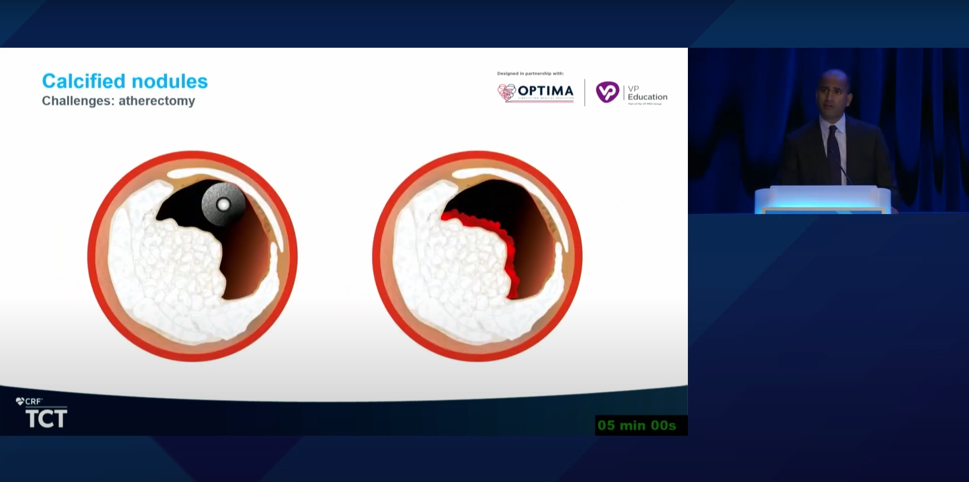 TCT 2022 Controversies in Calcium: An Open-Minded Debate on Approaches to Nodular Calcium