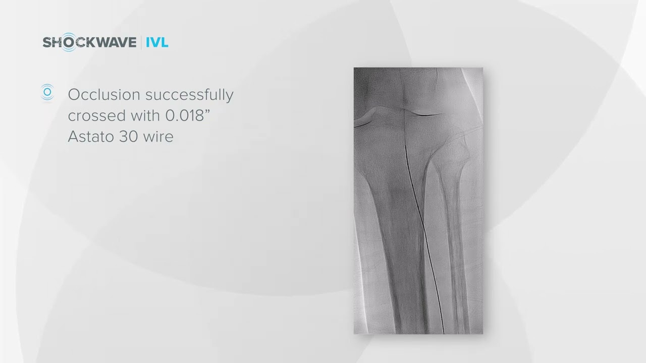 IVL Below The Knee - Shockwave Medical