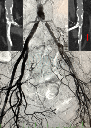 Shockwave IVL Pre-TAVI Tutorial Series 