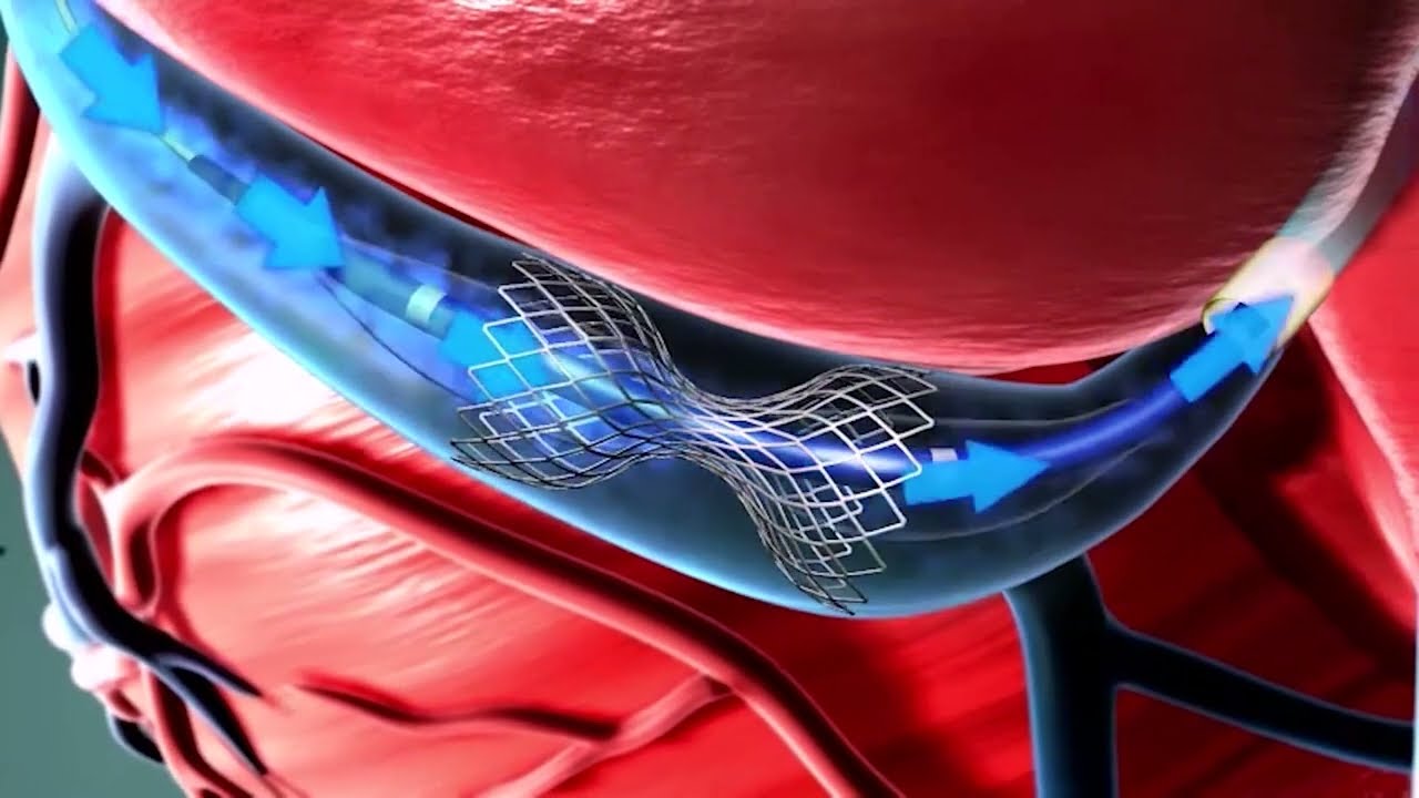 Coronary Sinus Reduction For Refractory Angina - Shockwave